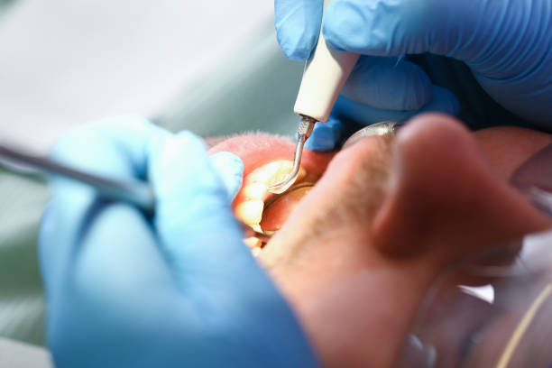 Best Emergency Dental Extractions in Chamblee, GA